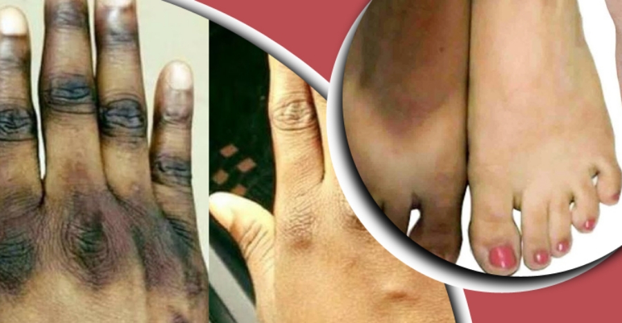 হাত-পায়ের গিঁটের কালো দাগ দূর করুন ঘরোয়া উপায়ে?