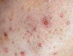 Picture for category Acne care