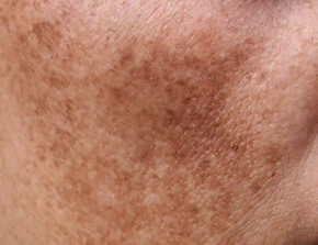 Picture for category Melasma